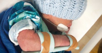 Kiwi invention to prevent NICU babies' skin injuries a success.jpg